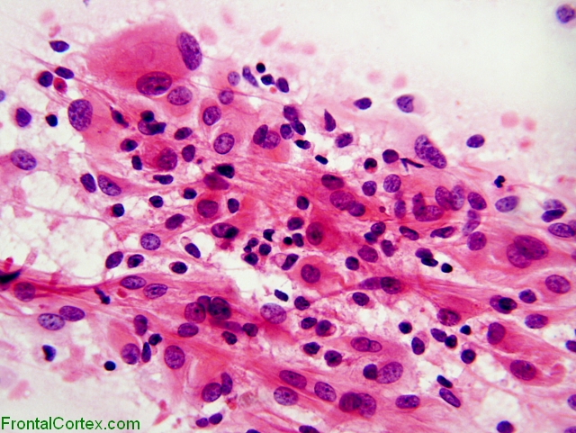 Rhabdoid meningioma, intraoperative smear preparation x 400